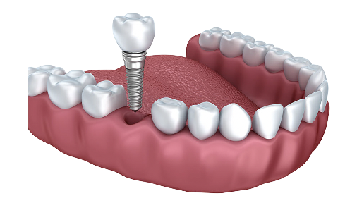 Dental Implants | Dentist Hailey Idaho | Best dentist Hailey Idaho | Implant dentist Hailey Idaho